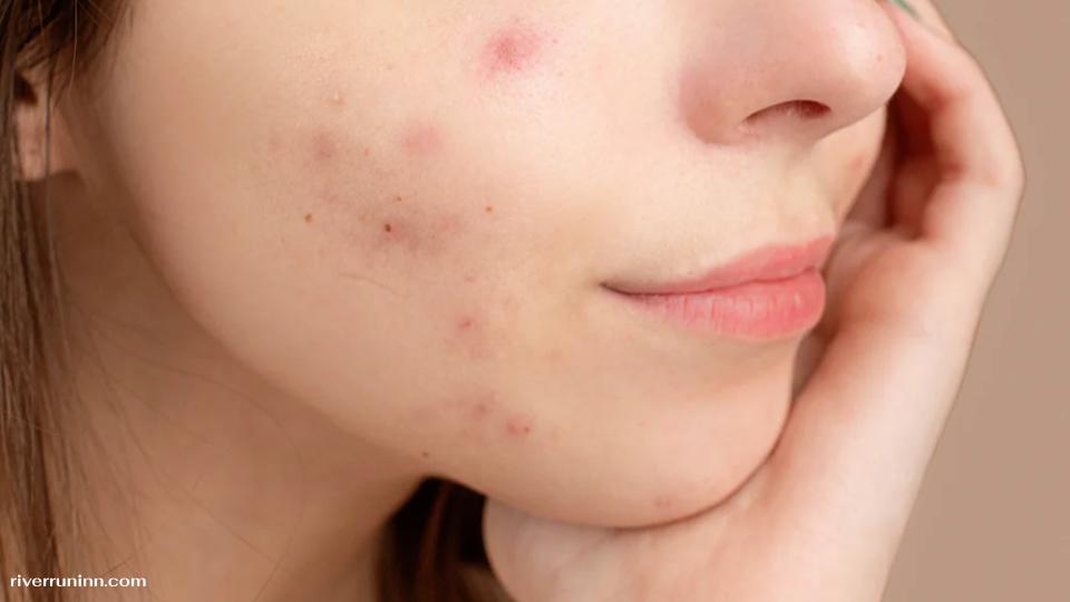 ปัญหาผิวหน้าที่พบบ่อย และกุญแจสำคัญสู่ความมั่นใจในทุกมิติ